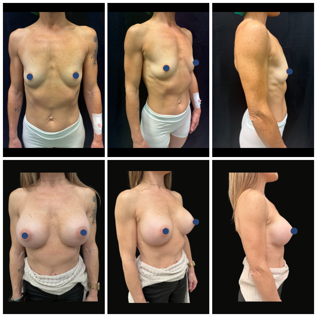 mastoplastica-additiva