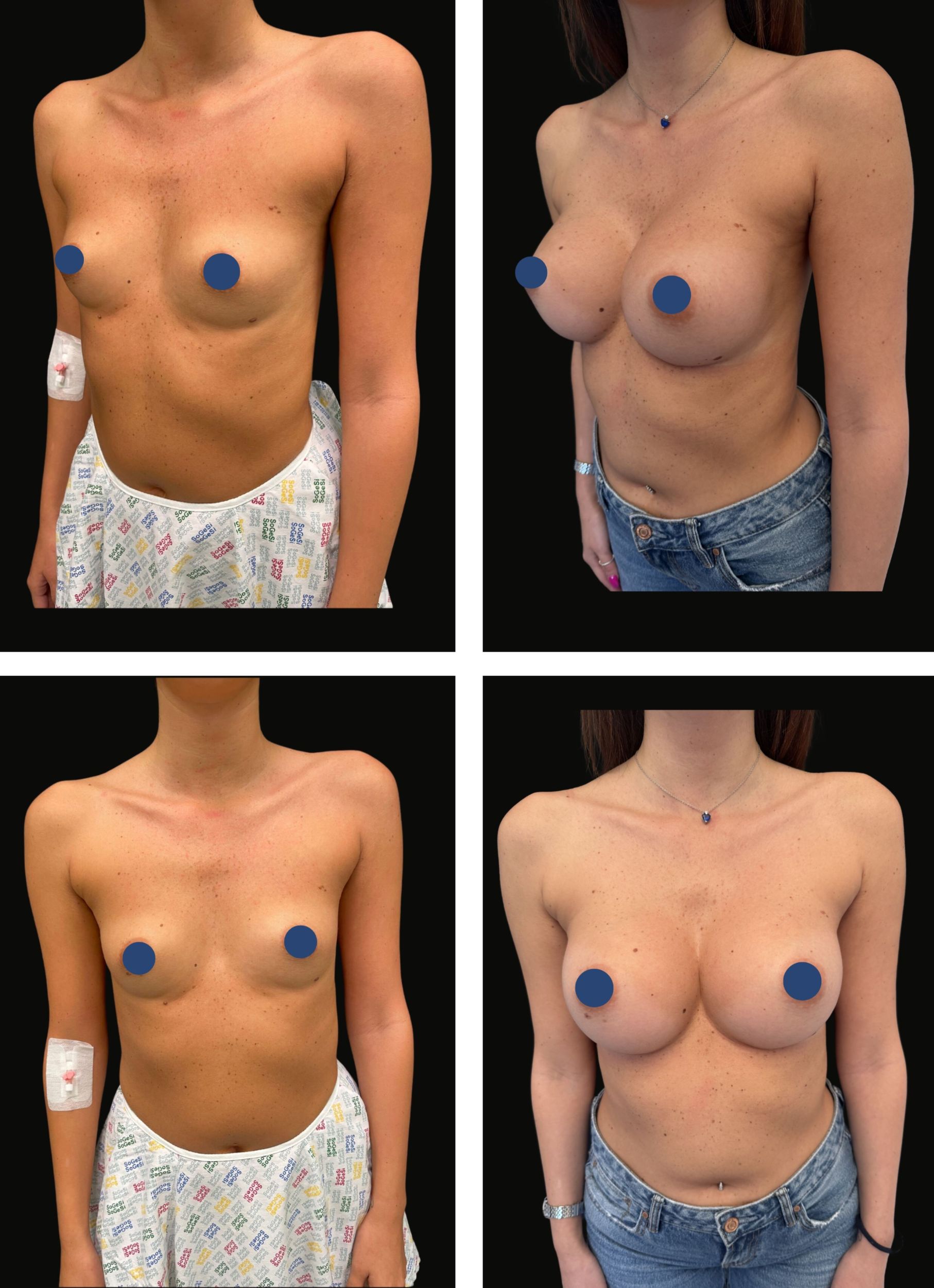 mastoplastica_additiva