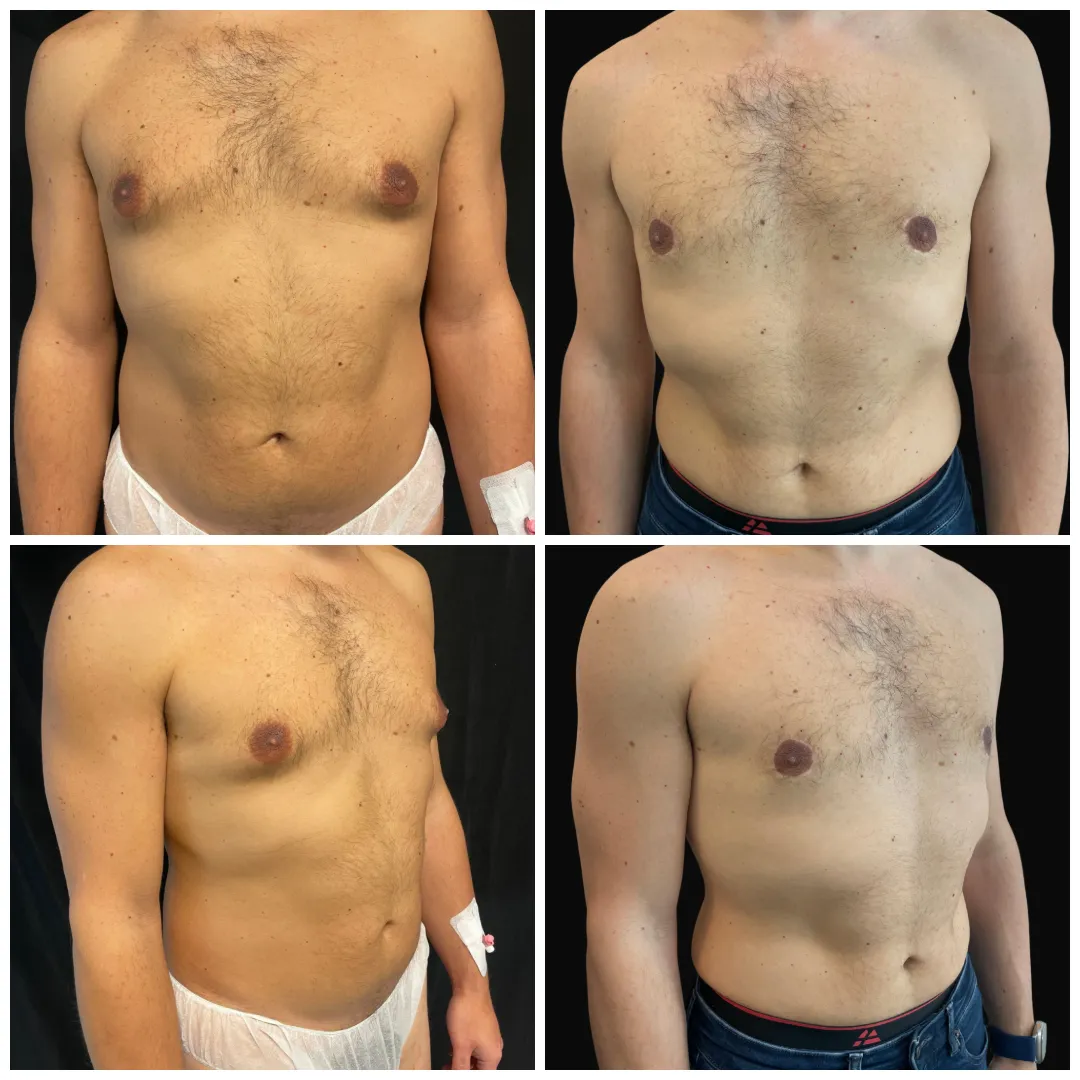 mastoplastica_additiva1