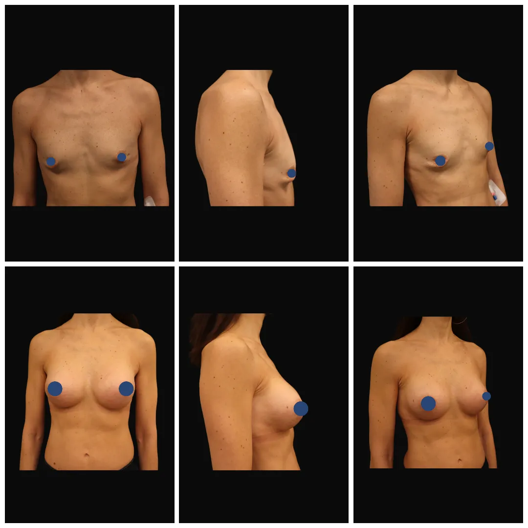 mastoplastica_additiva3