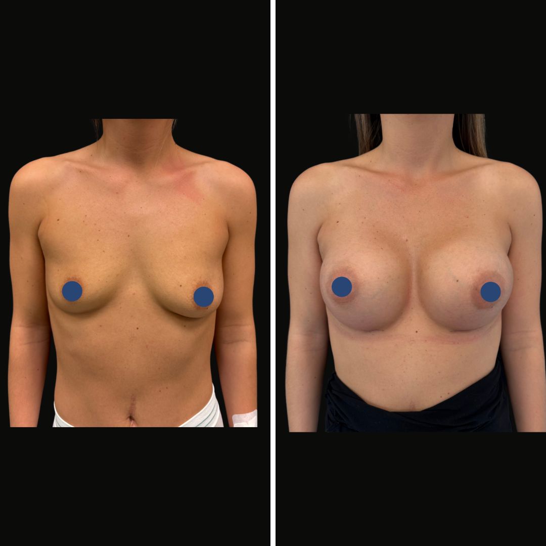 mastoplastica_additiva4