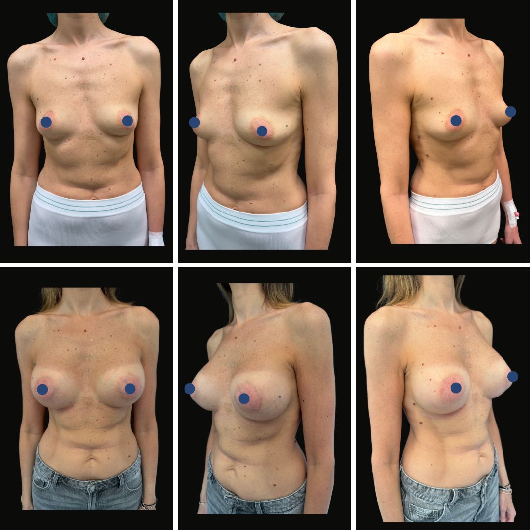 mastoplastica_additiva5