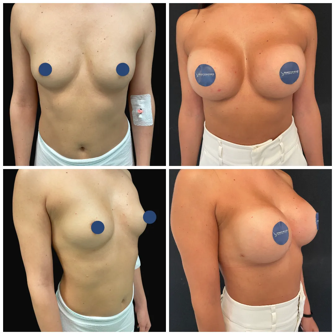 mastoplastica_additiva7