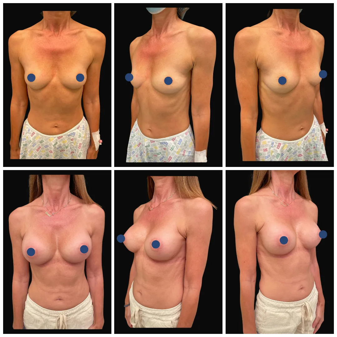 mastoplastica_additiva8