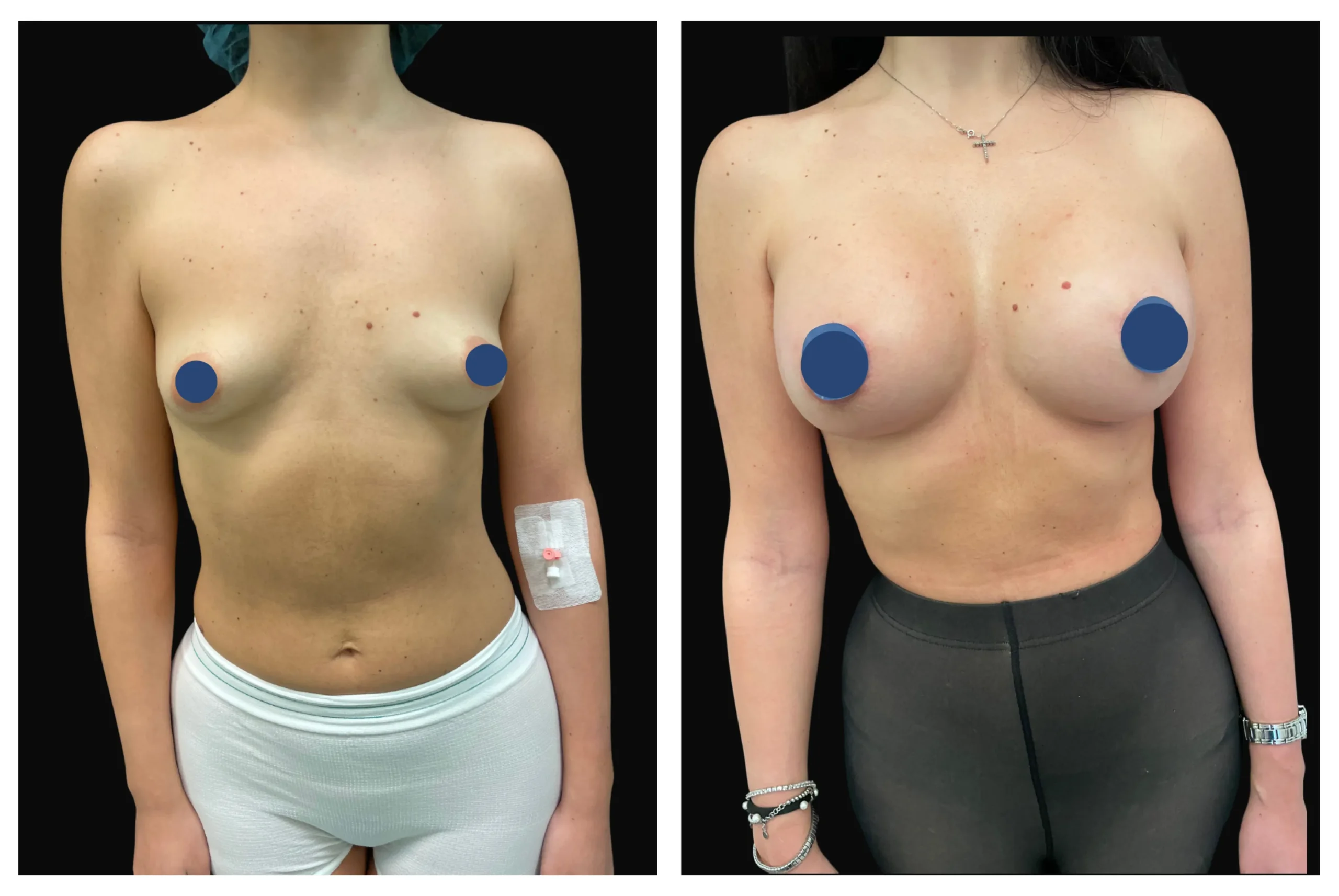 mastoplastica_additiva9