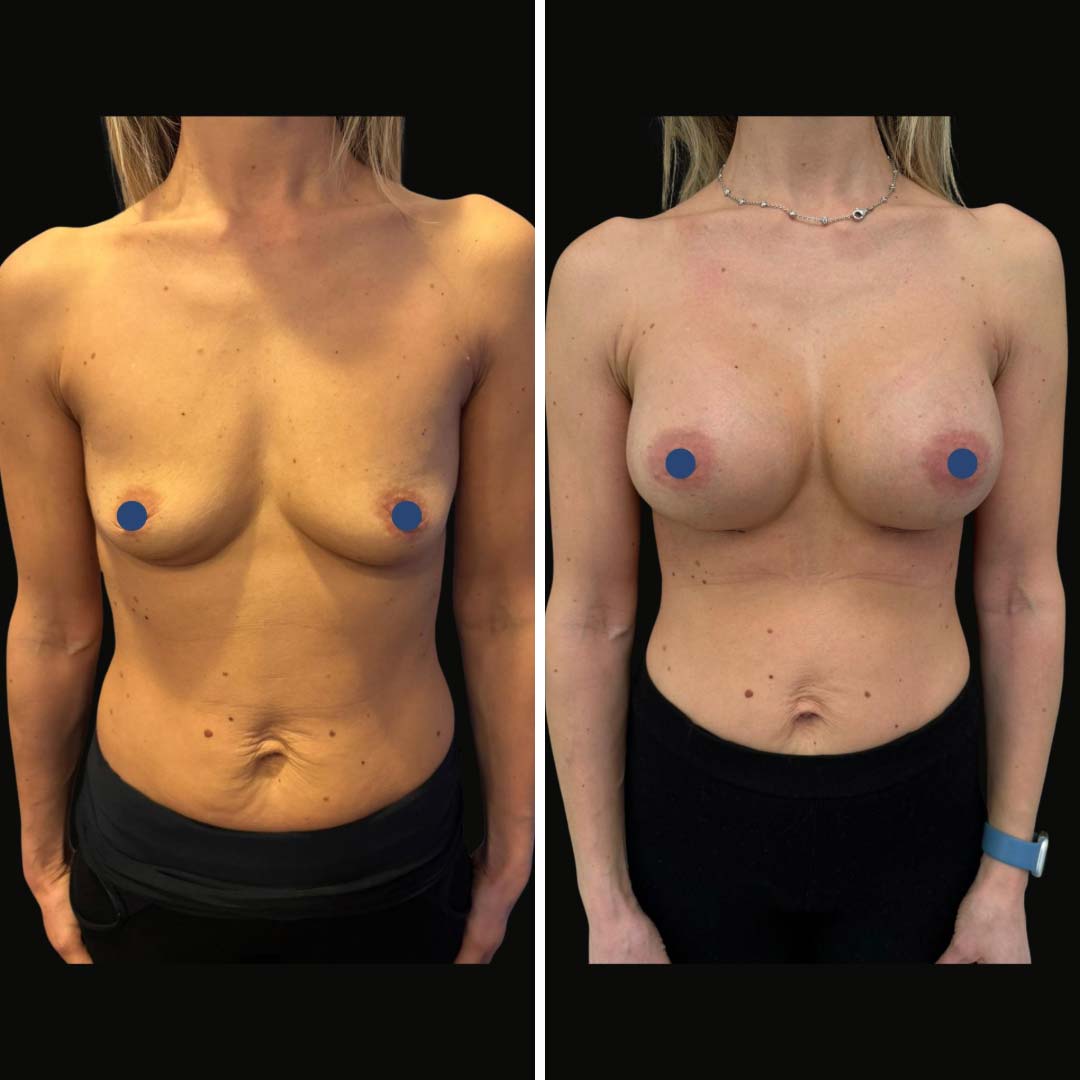 mastoplastica_additiva_10