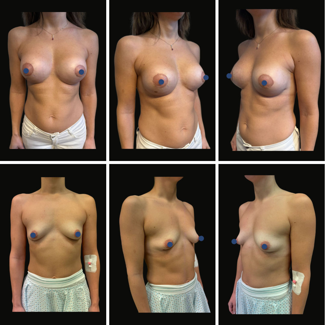 mastoplastica_additiva_12