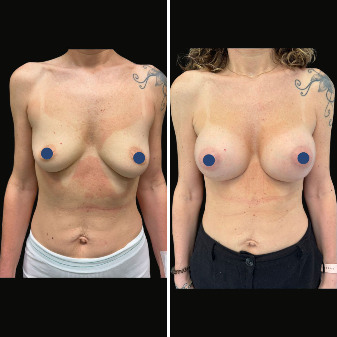 mastoplastica_additiva_9