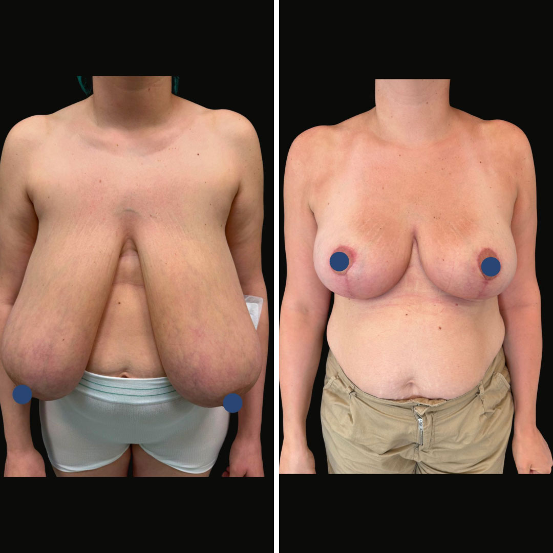 mastplastica_riduttiva_3