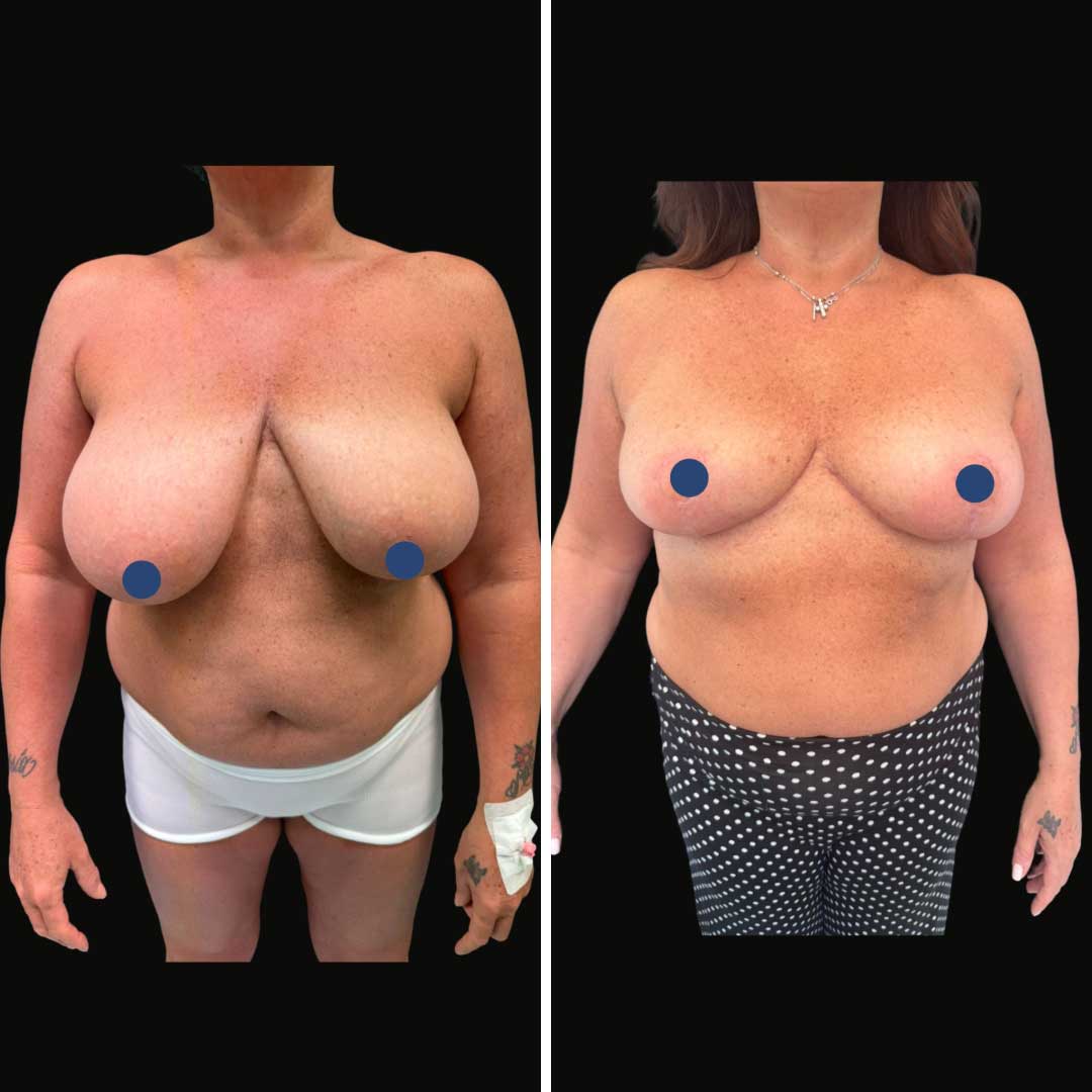 mastplastica_riduttiva_4