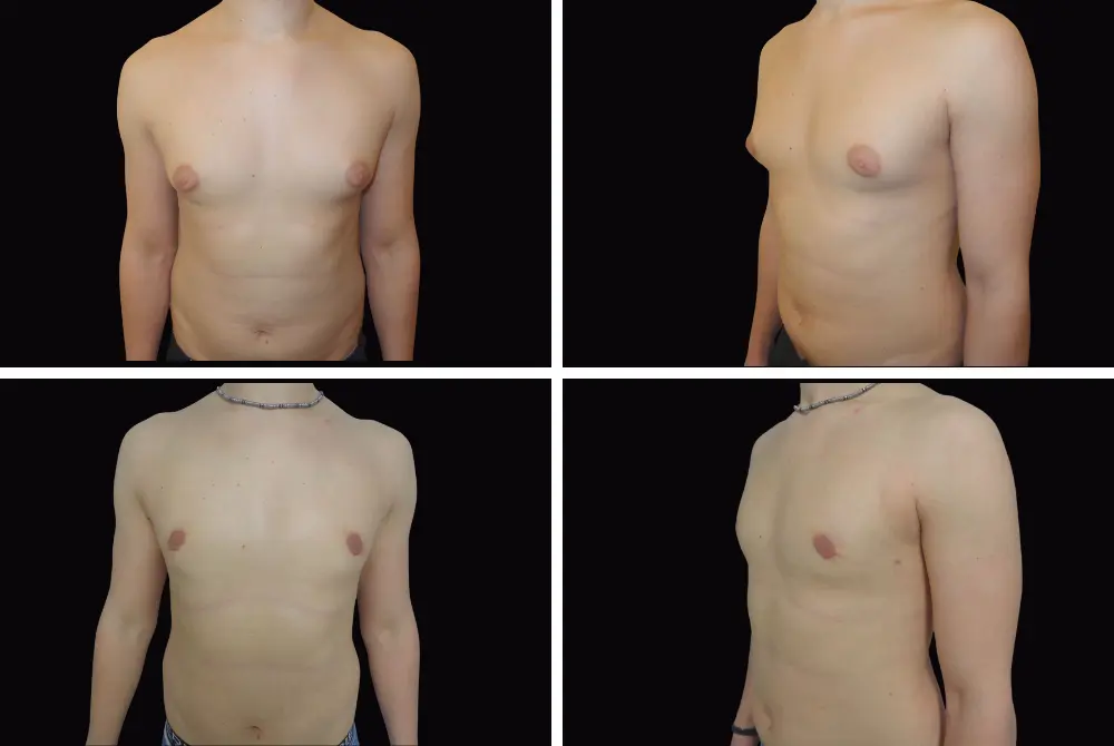 Ginecomastia 2