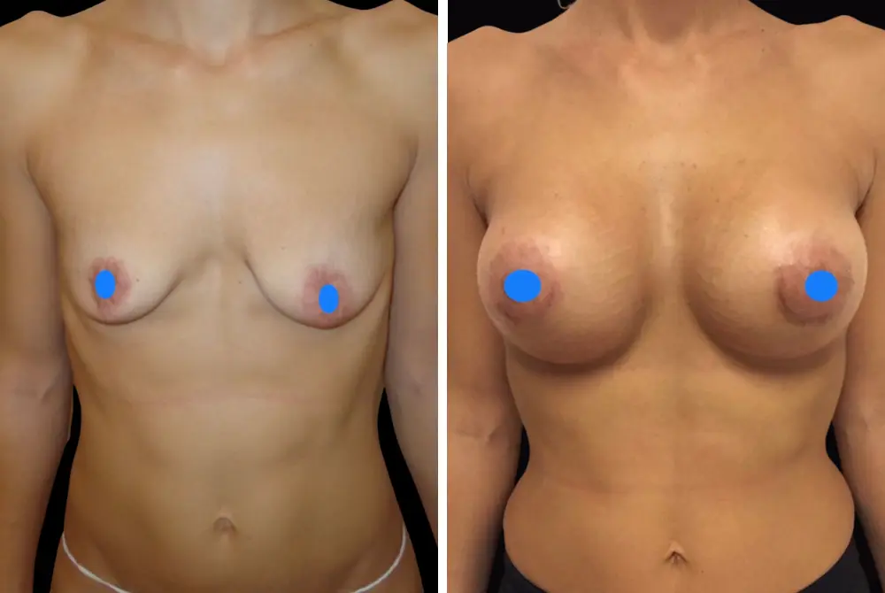 Mastoplastica Additiva (2) (1)