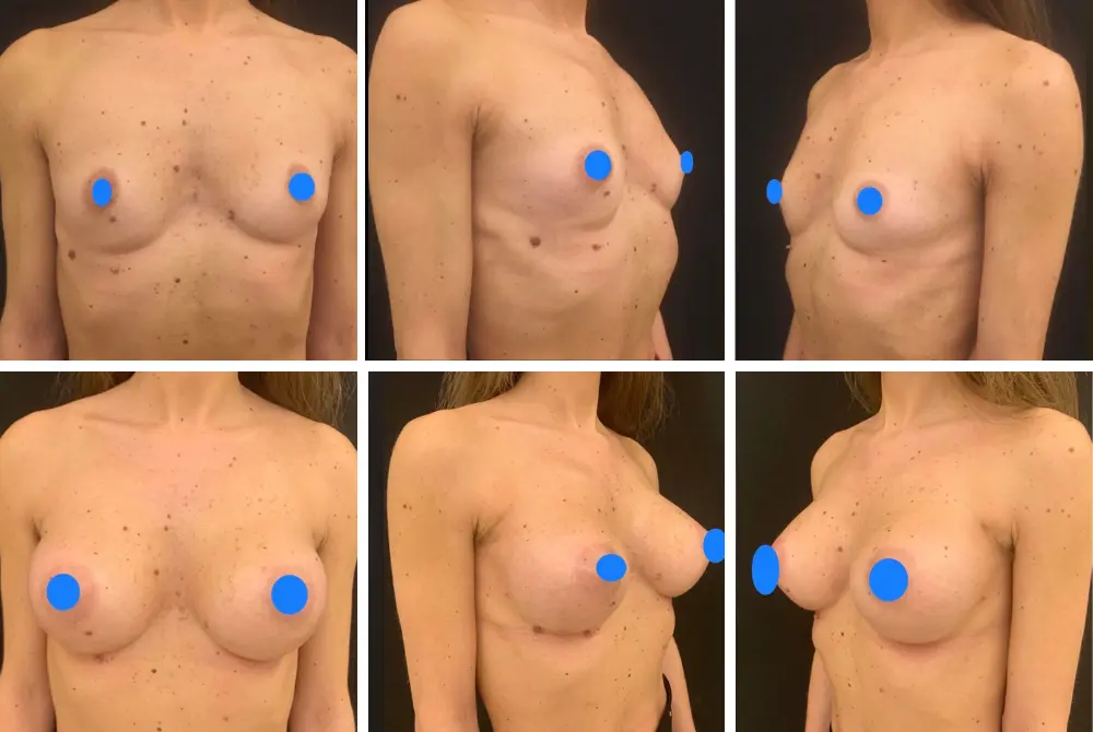 mastoplastica additiva-1